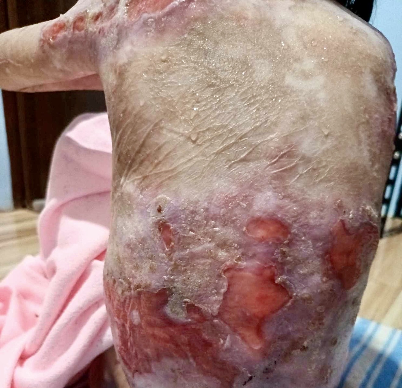 Please Donate to Stop Shamila's Severe Pain and Help Save Her Life — photo 2